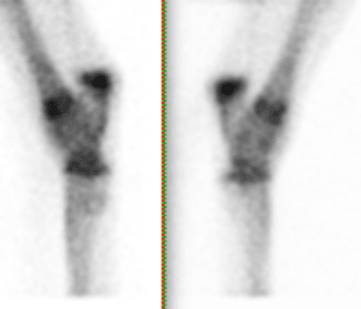 Lateral scintigraphy images with bilateral uptake in the subchondral bone of the tarsometatarsal joint.