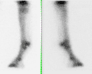 Lateral scintigraphy images showing the mild uptake in the left third metatarsal bone.
